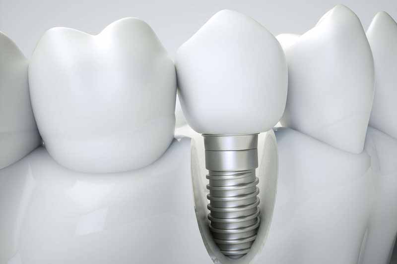 Implantes dentales en Alcorcon